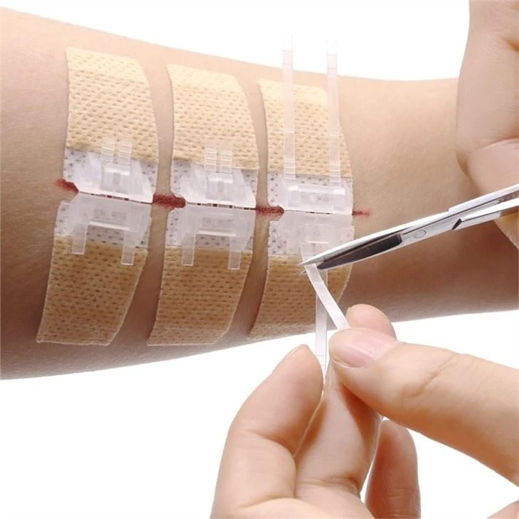 Wound Closure